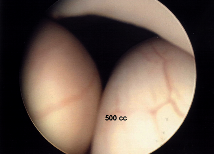 Separation of bowel loops with 500cc of Adept adhesion reduction solution. Moderate separation is shown